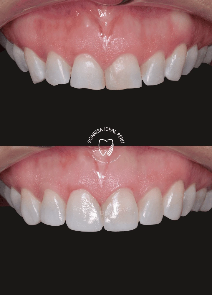 DIASTEMA - ESPACIOS ENTRE LOS DIENTES